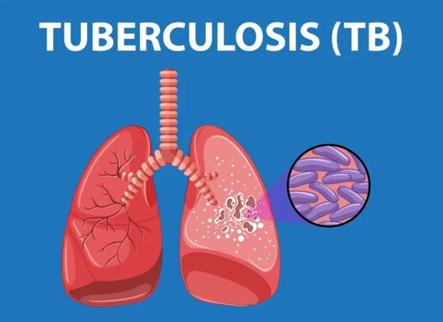 Multi-Drug Resistant Tuberculosis: Understand the Causes, Risk Factors, and Preventive Measures