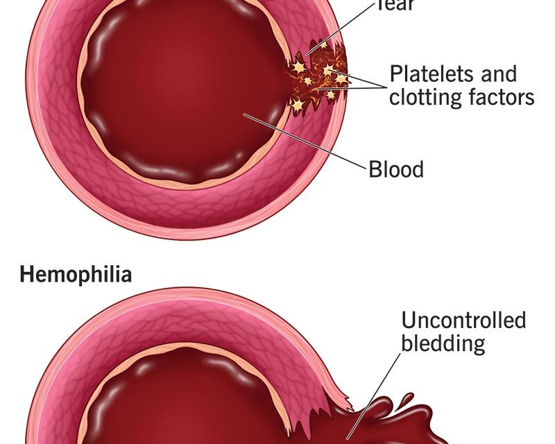 Lesser-known facts about hemophilia: Expert perspectives on the disease’s cause and effects on men