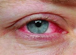 Despite recommendations, the majority of children and teenagers with pink eye were given needless antibiotics: study